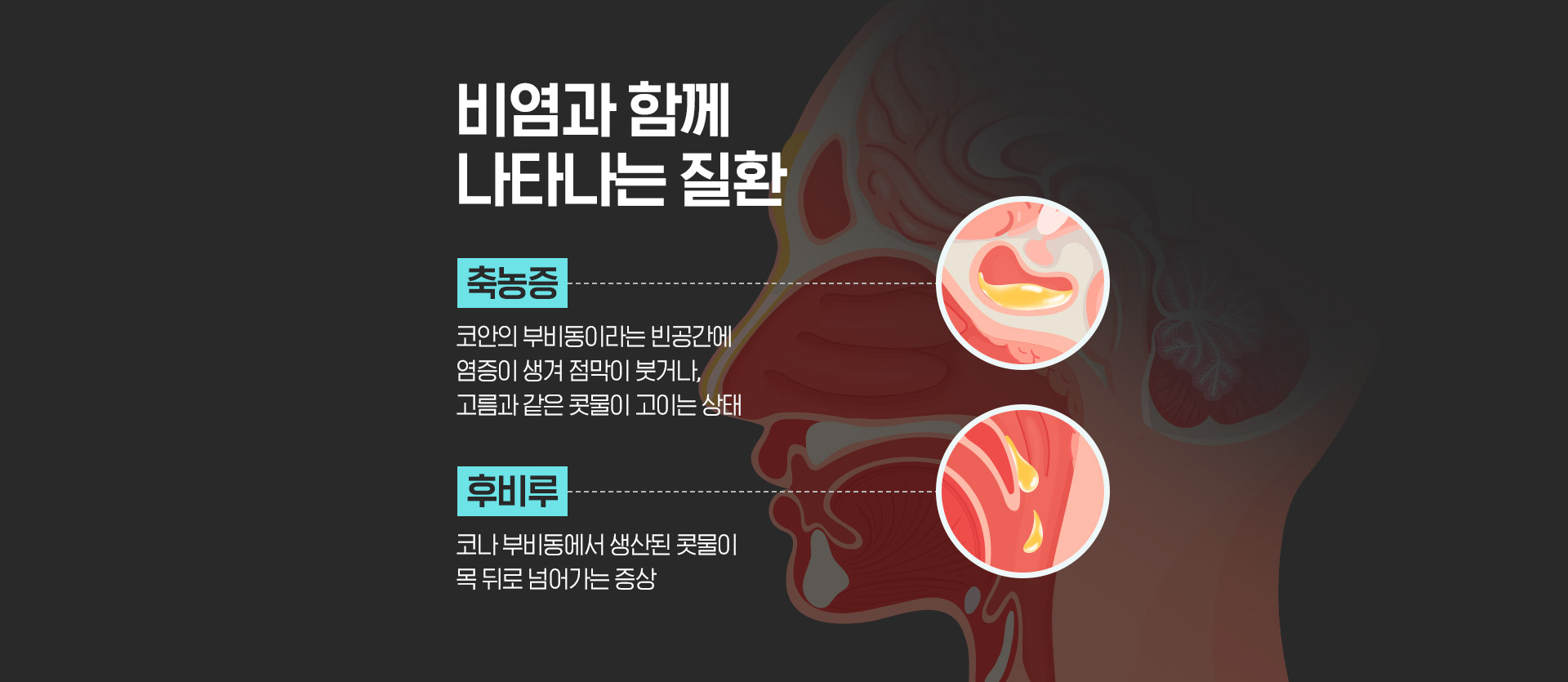 비염과 함께 나타나는 질환